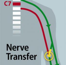 To detour around the block in this patient's C7 spinal cord injury and return hand function, Mackinnon operated in the upper arms. There, the working nerves that connect above the injury (green) and the non-working nerves that connect below the injury (red) run parallel to each other, making it possible to tap into a functional nerve and direct those signals to a non-functional neighbor (yellow arrow). To detour around the block in this patient's C7 spinal cord injury and return hand function, Mackinnon operated in the upper arms. There, the working nerves that connect above the injury (green) and the non-working nerves that connect below the injury (red) run parallel to each other, making it possible to tap into a functional nerve and direct those signals to a non-functional neighbor (yellow arrow).