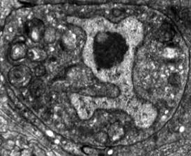This dying worm linker cell, captured by electron microscopy, has features in common with neurons that expire prematurely due to neurodegenerative disease. This dying worm linker cell, captured by electron microscopy, has features in common with neurons that expire prematurely due to neurodegenerative disease.