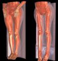This image represents 3-D reconstructions from CT scans of a healthy individual (left) and someone affected by a form of limb-girdle muscular dystrophy (right). The dramatic loss of muscle is easily seen. This image represents 3-D reconstructions from CT scans of a healthy individual (left) and someone affected by a form of limb-girdle muscular dystrophy (right). The dramatic loss of muscle is easily seen.