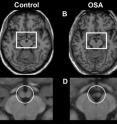 Brain scans reveal that the mammillary bodies (in box) of a sleep apnea patient (right) are smaller than those of a control subject (left). Brain scans reveal that the mammillary bodies (in box) of a sleep apnea patient (right) are smaller than those of a control subject (left).
