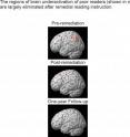 The regions of brain underactivation in poor readers (shown in red) are largely eliminated after remedial reading instruction.