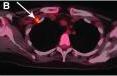 A 53-y-old woman with biopsy-proven right IBC. (A and B) Axial thoracic CT (A) and PET/CT (B) show solitary hypermetabolic, 1-cm medial subpectoral lymph node (arrow). (C) Transverse ultrasound shows abnormal solid, irregular,
hypoechoic lymph node in medial subpectoral region (arrow). An ultrasound-guided fine-needle aspiration confirmed metastasis.