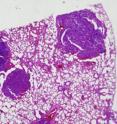 This is a section of lung tissue from a double knockout mouse, stained to show lung tumors. Mice lacking both the neil1 and nth1 genes were particularly prone to pulmonary and liver tumors during their second year. This is a section of lung tissue from a double knockout mouse, stained to show lung tumors. Mice lacking both the neil1 and nth1 genes were particularly prone to pulmonary and liver tumors during their second year.