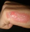 A new skin gel made of silver
nanoparticles may help improve
the treatment of burns,
researchers say.