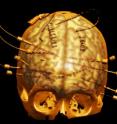 This is a brain scan showing electrodes that surgeons use to find and remove the source of seizures (to cure epilepsy) while sparing the source of mental functions like language. This is a brain scan showing electrodes that surgeons use to find and remove the source of seizures (to cure epilepsy) while sparing the source of mental functions like language.