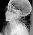 This cross-table X-ray image of the head of an ancient Egyptian mummy was taken recently with new digital medical imaging technology. It is exceptionally clear and reveals a previously unknown erosion of the parietal lobes in the mummy's skull. This could indicate the presence of parasites, anemia, or malnourishment shortly before death. Note the material under the mummy's chin, likely a fat-filled linen wadding used in mummies to give the neck a natural shape.
