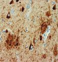 Tissue from the hippocampal region of the brain is stained brown to display the tau protein. The triangular shapes are neurofibrillary tangles. Amyloid plaques are the round, less dense structures, which contain amyloid-beta, but are stained only for tau in this image.