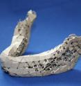 An individual jawbone implant "baked" from powdered metal.