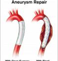 Aneurysm repair with open surgery and with stent.
