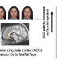 The degree of increased activity in a mood regulating hub called the anterior cingulate (arrow) in response to flashing frightful faces predicted a patients' response to a fast-acting antidepressant mechanism. MEG data superimposed on anatomical MRI image of the brain.