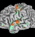 Activation of the left cerebral hemisphere during sensory stimulation of the transplanted right palm as viewed by enhancement of fMRI findings.