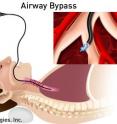 This is an airway bypass procedure uses stents to create new pathways in the diseased lung.