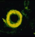 A ring of amyloid is visible in the wall of an arteriole in the brain of
a patient who had Alzheimer's disease. The tissue has been stained with
Thioflavin S so that the amyloid fluoresces in yellow.