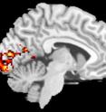 An MRI of the brain that shows increased activity when patients use their preferred retinal locations.