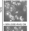 This trio of images show cancer cells that are normally non-aggressive and slow growing. The top image shows the cells in their typical state. In the middle image, the cells have lost the p53 tumor suppressor gene and are  dividing much more aggressively. Cells in the final image have acquired the RAS oncogene and have started invading surrounding tissue.