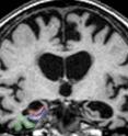 The MRI brain shows severe atrophy indicative of Alzheimer's pathology in all three areas, except the right perirhinal cortex, which has moderate atrophy.