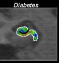 Cerebral blood volume (CBV) maps are shown for a subject with diabetes. Maps are color-coded with warmer colors indicating greater CBV or activity.