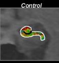 Cerebral blood volume (CBV) maps are shown for an individual control. Maps are color-coded with warmer colors indicating greater CBV or activity.