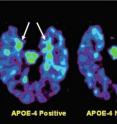 PET brain scans reveal plaque and tangle accumulation in patients with the APOE-4 gene, which increases risk of Alzheimer's.