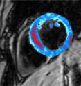 The colored area on this MRI scan shows a cross-section of the heart muscle, with the area of bleeding shown in red.