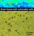 This is an iron map of brain tissue with vulnerable cells relating to Parkinson's disease.