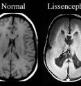 This is a scan of the cerebral cortex showing lissencephaly.