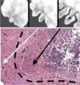 These computer-generated depictions of a growing brain tumor show growth at six, eight and 12 months (top, left to right), with development of infiltrative cell front (arrow) at 12 months. Tissue slide (bottom) shows tumor finger (black arrow) advancing in substrate gradient (white arrow).