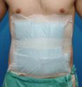 This photo shows a patient after abdominal surgery at the department of surgery at Heidelberg University Hospital. The patients got a dressing over the entire abdomen, so that they do not know which incision was made.