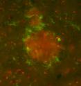 Microglia (in green) attack the beta amyloid (red) deposited in the brain of a GCSF-treated Alzheimer's mouse.