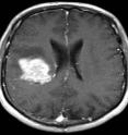 This brain scan shows the white mass of a solid tumor at left.  The lack of water movement in the tumor and surrounding tissue suggests that this tumor would not be a good candidate for treatment by Avastin.