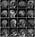 This image shows MRI scans of normal patients (a, b) and patients with missing or affected FOXC1 genes or larger gene deletions.