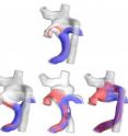 (Top) This is a 3-D model of hepatic flow distribution pre-surgery. (Bottom) These are post-surgery hepatic flow distribution options. The surgeon ultimately selected the third option, which exhibited the best performance with regard to hepatic factor distribution to the left and right lungs.