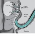 Tiny particles pass through the catheter and wedge in the small vessels, blocking the blood flow to the fibroid.