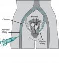 A catheter is inserted through a nick in the skin into an artery and advanced to the uterus.
