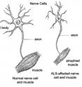 In amyotrophic lateral sclerosis (ALS), often referred to as Lou Gehrig's disease,  motor neurons degenerate, as pictured, and eventually die. When the motor neurons die, the ability of the brain to initiate and control muscle movement is lost.