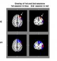 "Naives" with minimal prior Internet search experience (top), and "Savvies" with a lot of Web search experience (bottom). Overlay of first brain scan results (blue) and second brain scan results (red).  Note that the second brain scan reveals that "Naïves" have more activation of the frontal part of the brain that is involved in working memory and decision-making.