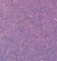 The spleen of mice overexpressing the oncogene c-myc and the anti-apoptotic protein MCL-1 is crowded with leukemia cells. The spleen of mice overexpressing the oncogene c-myc and the anti-apoptotic protein MCL-1 is crowded with leukemia cells.
