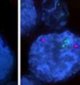 Genes including ERBB2 (green) and MYC (red) are positioned differently in normal (left) and cancerous (right) tissue.