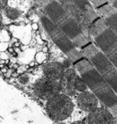Membranous vacuoles corresponding to nondegradative autophagosomes accumulate in muscle expressing mutated VCP.
