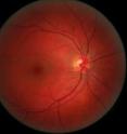 The largest study to date of proteins in the retina, above, indicate that high blood pressure drugs may be useful in preventing diabetic eye disease.