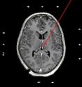 The habenula is a tiny double structure in the diencephalon. For stimulation two electrodes are implanted. The picture shows the pathway of an electrode in the brain.