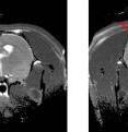 Adult "schizophrenic" rats (middle) have larger lateral ventricles than those of normal rats (left), but become smaller after preventive treatment with clozapine in adolescence (right).