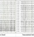 These raw EEG tracings during eyes-closed rest (left) and Transcendental Meditation (right) represent 18 tracings over 6 seconds. The top tracings are from frontal sensors; the middle tracings are from central sensors; the bottom tracings are from parietal and occipital sensors (back). Note the high-density alpha activity in posterior leads during eyes-closed rest, and the global alpha bursts across all brain areas during Transcendental Meditation practice.