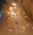 In the first study of its kind in the United States, Henry Ford Hospital showed that skin transplant surgery is safe and effective for treating vitiligo.