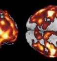 Two views of a composite image of the brains analyzed in Dr. Mosconi's study highlight the average increase in amyloid-beta deposits among 14 healthy adults with a mother affected by Alzheimer's. Regions in yellow have 4 times more amyloid than the corresponding regions of 14 healthy counterparts with no family history of dementia, while regions in red have twice as much amyloid.