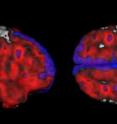 Two views of a composite image of the brains analyzed in the study compare the average increases in amyloid-beta deposits in volunteers with a maternally or paternally inherited risk of Alzheimer's, compared to counterparts with no family history of dementia. Red highlights the regions with more amyloid among 14 volunteers with a maternally inherited risk, while blue shows the regions with more amyloid among 14 volunteers with a paternally inherited risk. Purple denotes higher amyloid deposits in both risk groups.