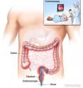 In a colonoscopy, a colonoscope is inserted through the anus and rectum and into the colon. The inset shows a patient on a table having a colonoscopy. In a colonoscopy, a colonoscope is inserted through the anus and rectum and into the colon. The inset shows a patient on a table having a colonoscopy.