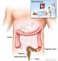 In a sigmoidoscopy, a sigmoidoscope is inserted through the anus and rectum and into the sigmoid colon. The inset shows a patient on a table having a sigmoidoscopy. In a sigmoidoscopy, a sigmoidoscope is inserted through the anus and rectum and into the sigmoid colon. The inset shows a patient on a table having a sigmoidoscopy.