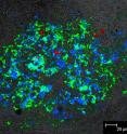In healthy individuals, protective white blood cells called monocytes travel from bone marrow to the bloodstream to the brain. Researchers from Boston College, examining the role of monocytes in the progression of AIDS brain disease, show in this image the presence of macrophages -- white blood cells located within tissues -- that are both productively infected with AIDS and cells that are non-productively infected. In this image taken from the brain of a monkey infected with simian immunodeficiency virus, or SIV, the red-colored cells labeled with BrdU+ from the bone marrow, were non-productively infected. Yet they were present in the brain lesion of the animal alongside productively infected green SIVp28 cells and blue CD68+ macrophages. The tracking of the BrdU cells to the SIV brain lesions is a critical finding, placing the non-productively infected cells in sites of active viral replication.