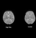 The infant's brain image on left shows the larger lateral ventricles and a generally larger brain overall.